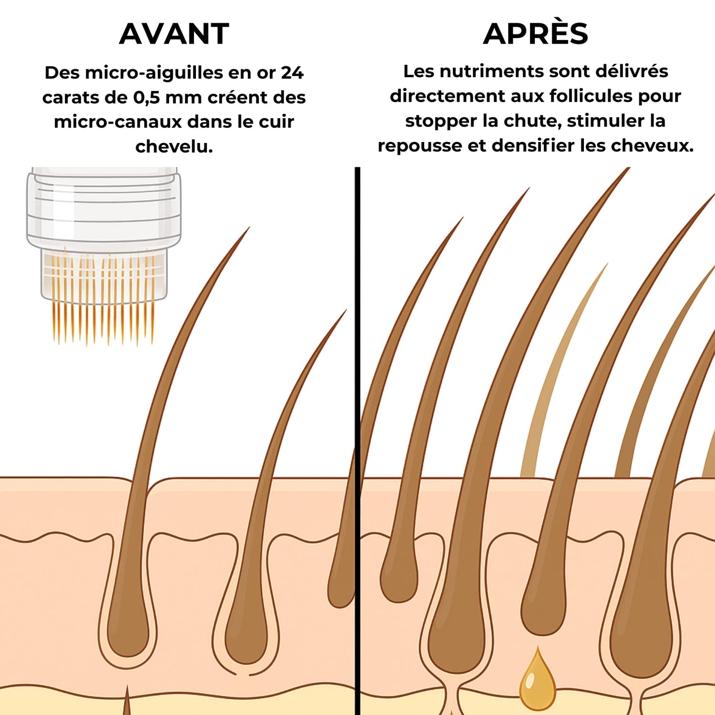 Follicus™ Thérapie de Repousse Capillaire