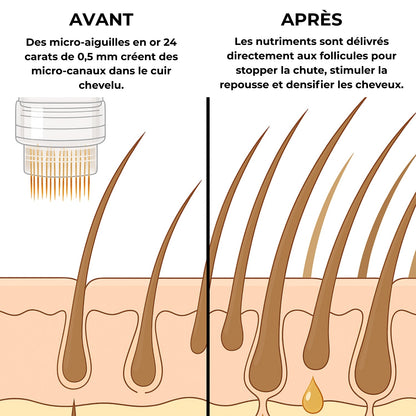 Follicus™ Thérapie de Repousse Capillaire