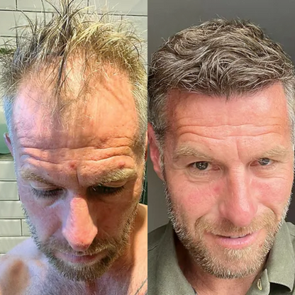 Follicus™ Thérapie de Repousse Capillaire